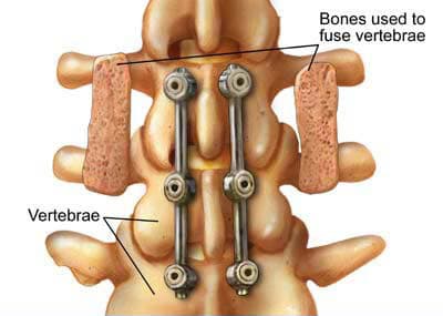 Post-Laminectomy Syndrome