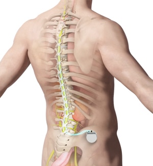 Spinal Cord Stimulator