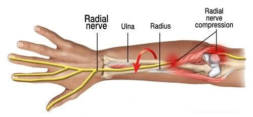 Radial Tunnel Syndrome